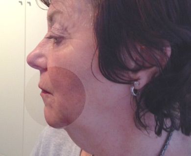 Photo of client after treatment.