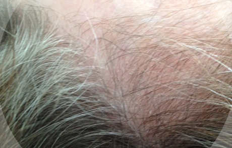Photo of client after treatment.
