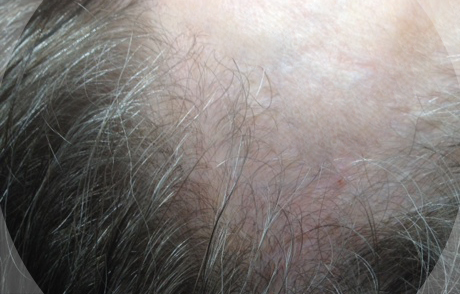 Photo of client before treatment.